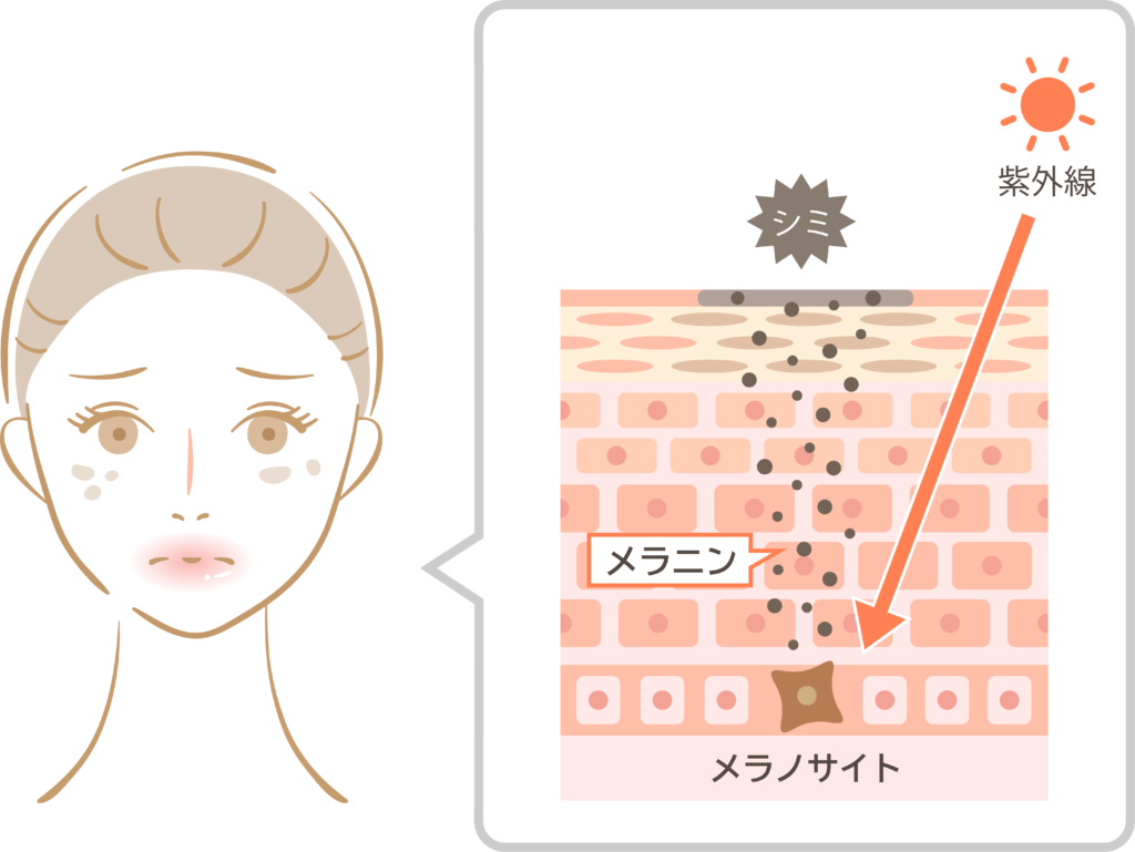 メラニンが原因のシミ